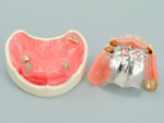 精密入れ歯のコーヌスアタッチメント