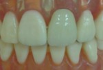 前歯にウイングアタッチメントの義歯